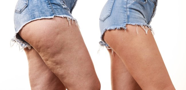 cellulite difference avant apres utilisation huiles essentielles